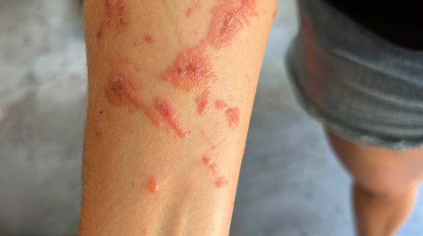 Poisonous Plant reaction