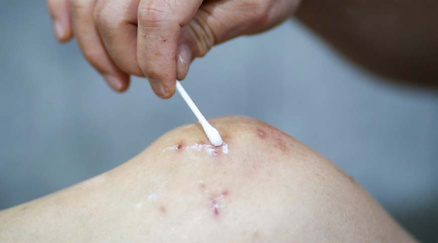 Poisonous Plant first aid